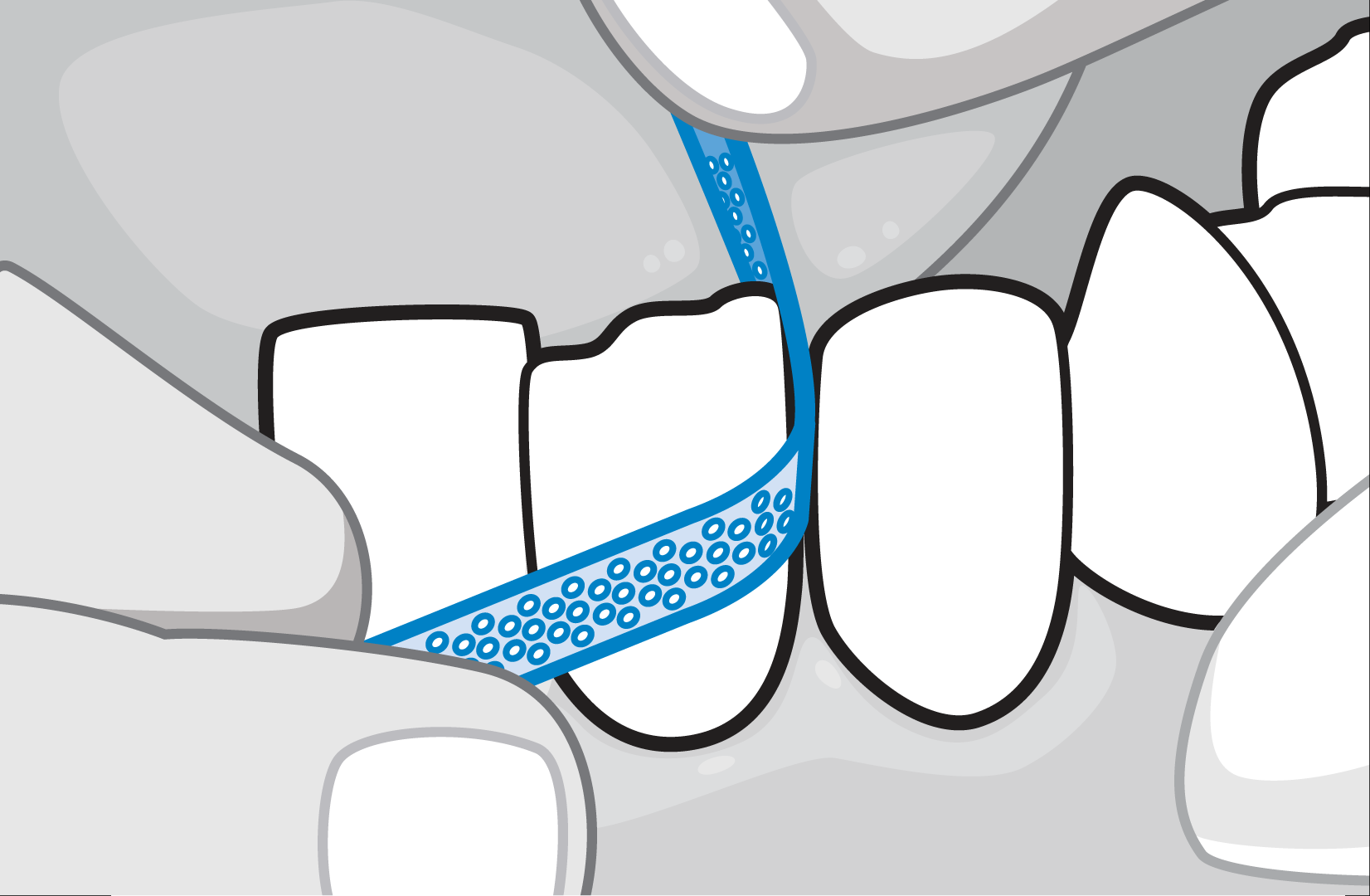 Attachments Bonding and Interproximal Reduction