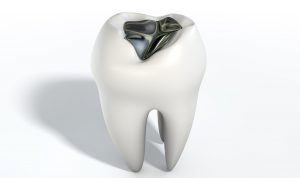 Amalgam Filling